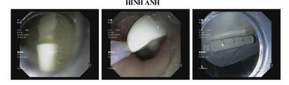 Gắp thành công bàn chải dài 30cm trong dạ dày người bệnh